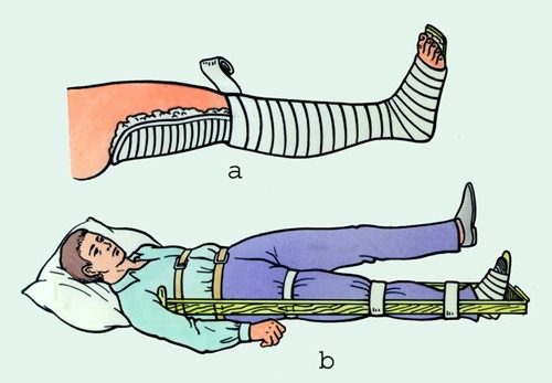 Sơ Cứu Gãy Chân